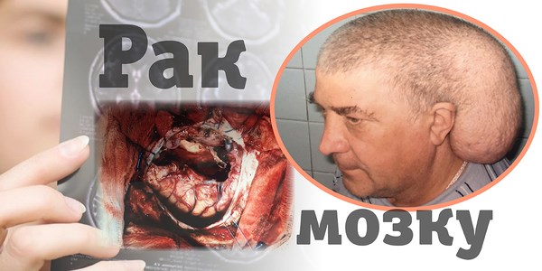 Киевские врачи спасли жизнь шахтеру из Горловки, удалив огромную раковую опухоль на голове
