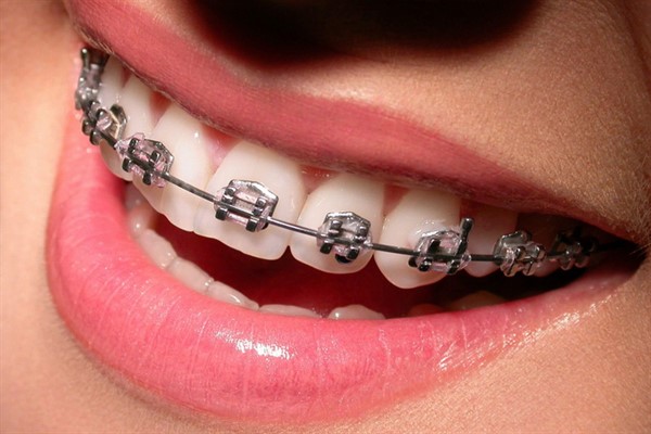 Металлические брекеты – правильный прикус, ровные зубы