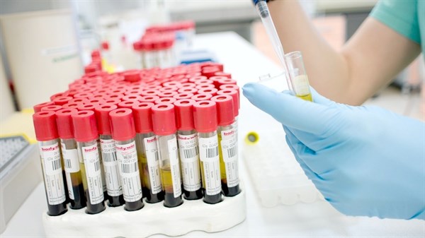 Как провести лабораторное исследование крови на содержание в ней мочевой кислоты 