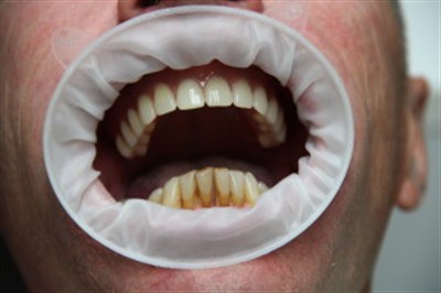Комфортный метод восстановления утраченных зубов - протезирование