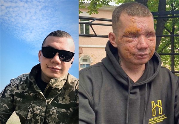 Украинский военнослужащий родом из Горловки потерял слух и зрение при разминировании. Ему нужна помощь