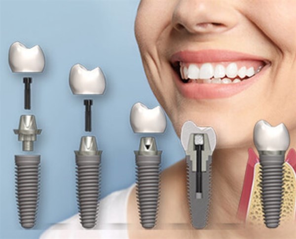Імплантологія зубів: сучасні тенденції та технології відновлення здоров’я та естетики усмішки