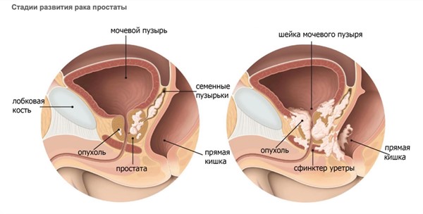 Стадии развития рака предстательной железы