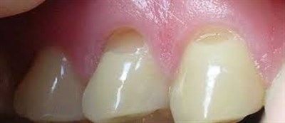 Клиновидный дефект зубов: где и как лечить 