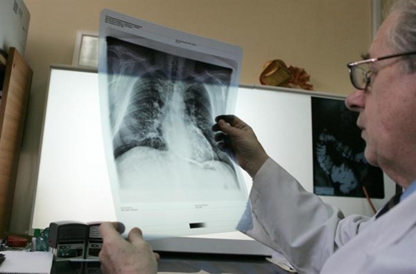 Горловчане, болеющие туберкулезом, теперь не смогут поправить свое здоровье в санаториях Крыма 