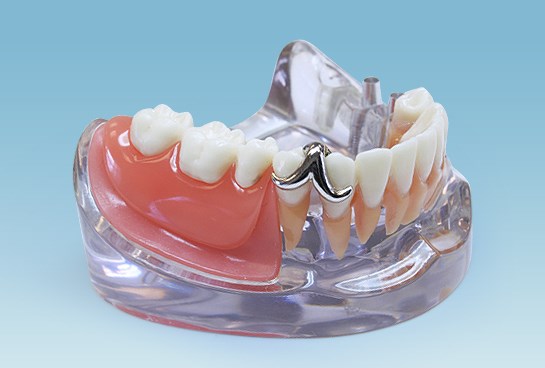 Протезирование зубов: лучшая клиника с современными технологиями 