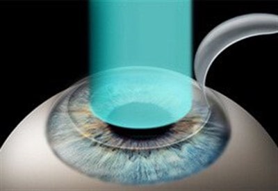 Лазерная коррекция зрения: взгляд на мир собственным глазами